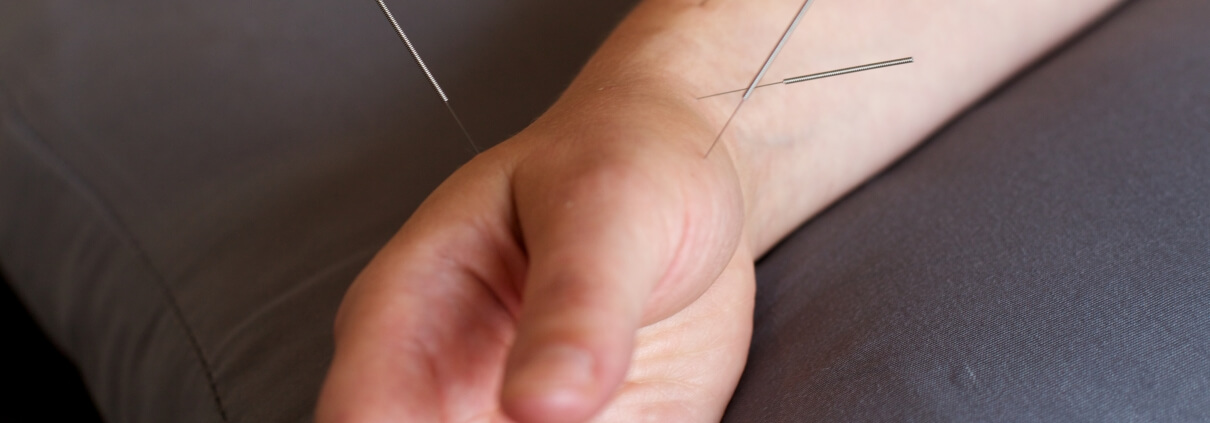 Acupuncture in Milton