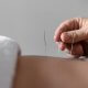 Acupuncture Therapy in Milton