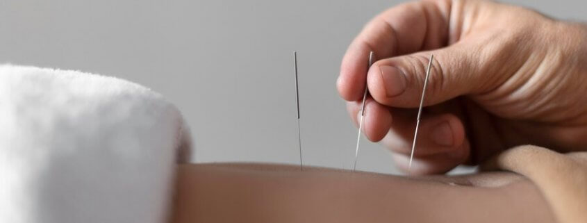 Acupuncture Therapy in Milton